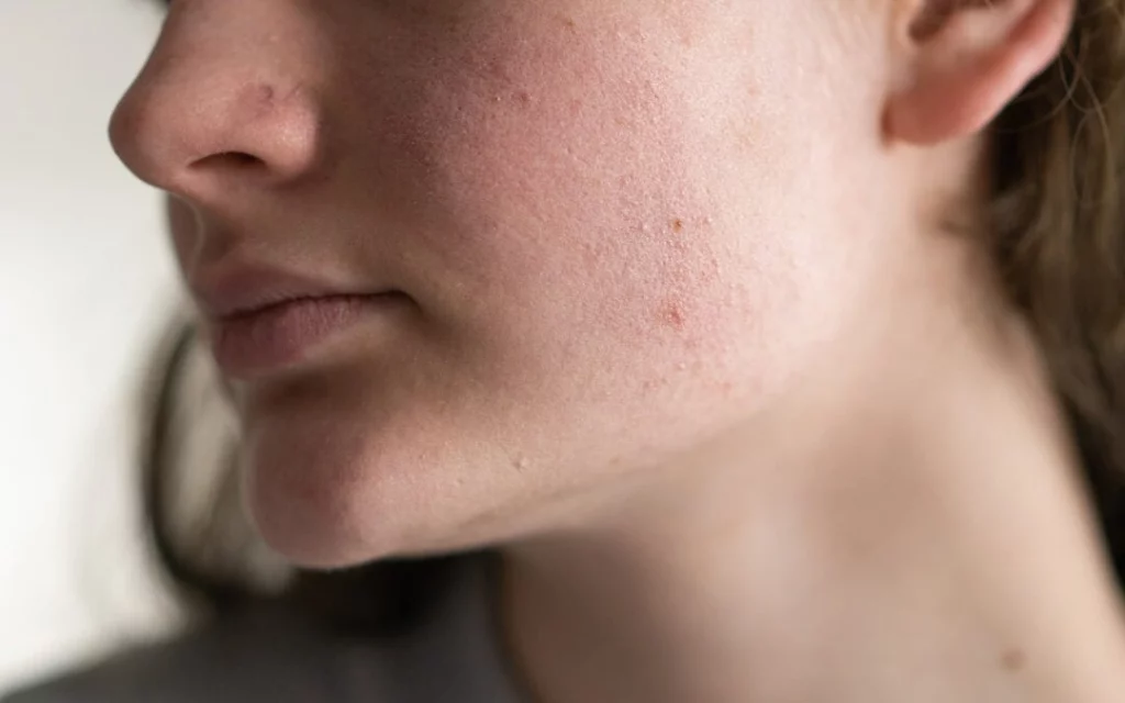 Skin Irritation, Red Marks, or Pressure Sores